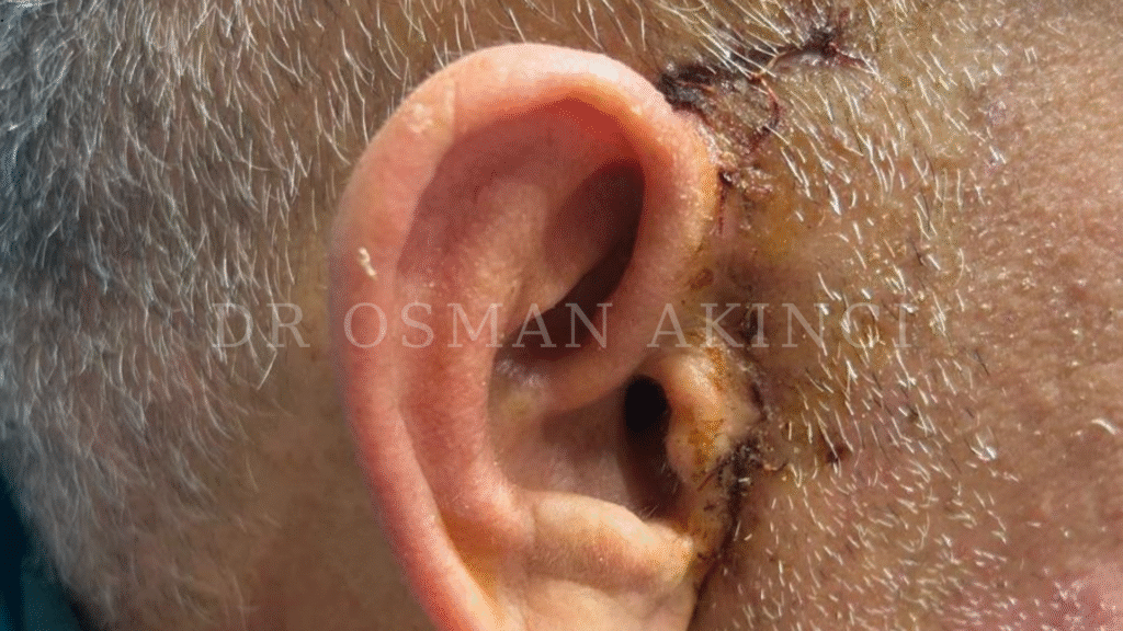 TMJ Ankylosis Surgery