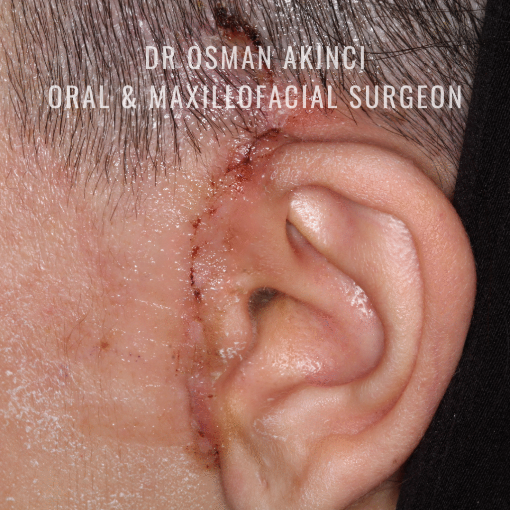 TMJ Surgery, TMJ open surgery
