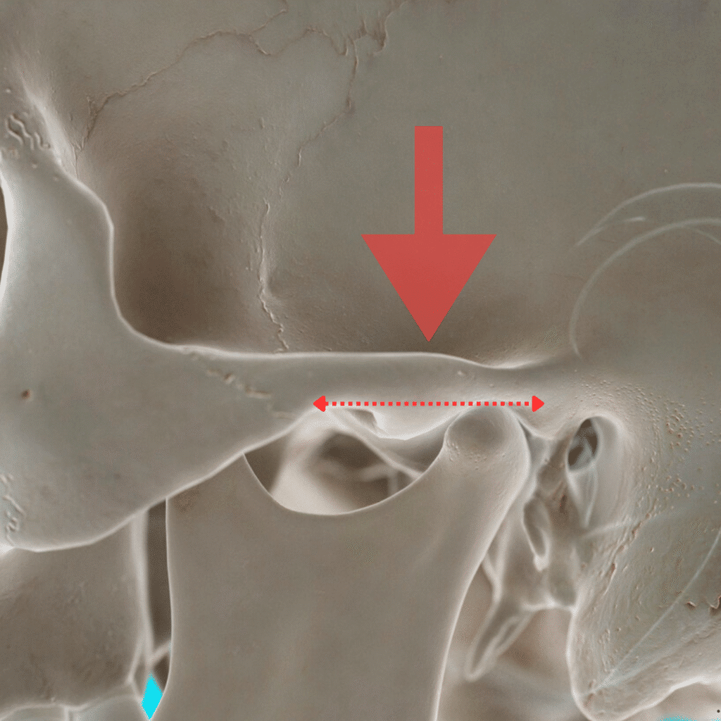 TMJ eminectomy surgery
