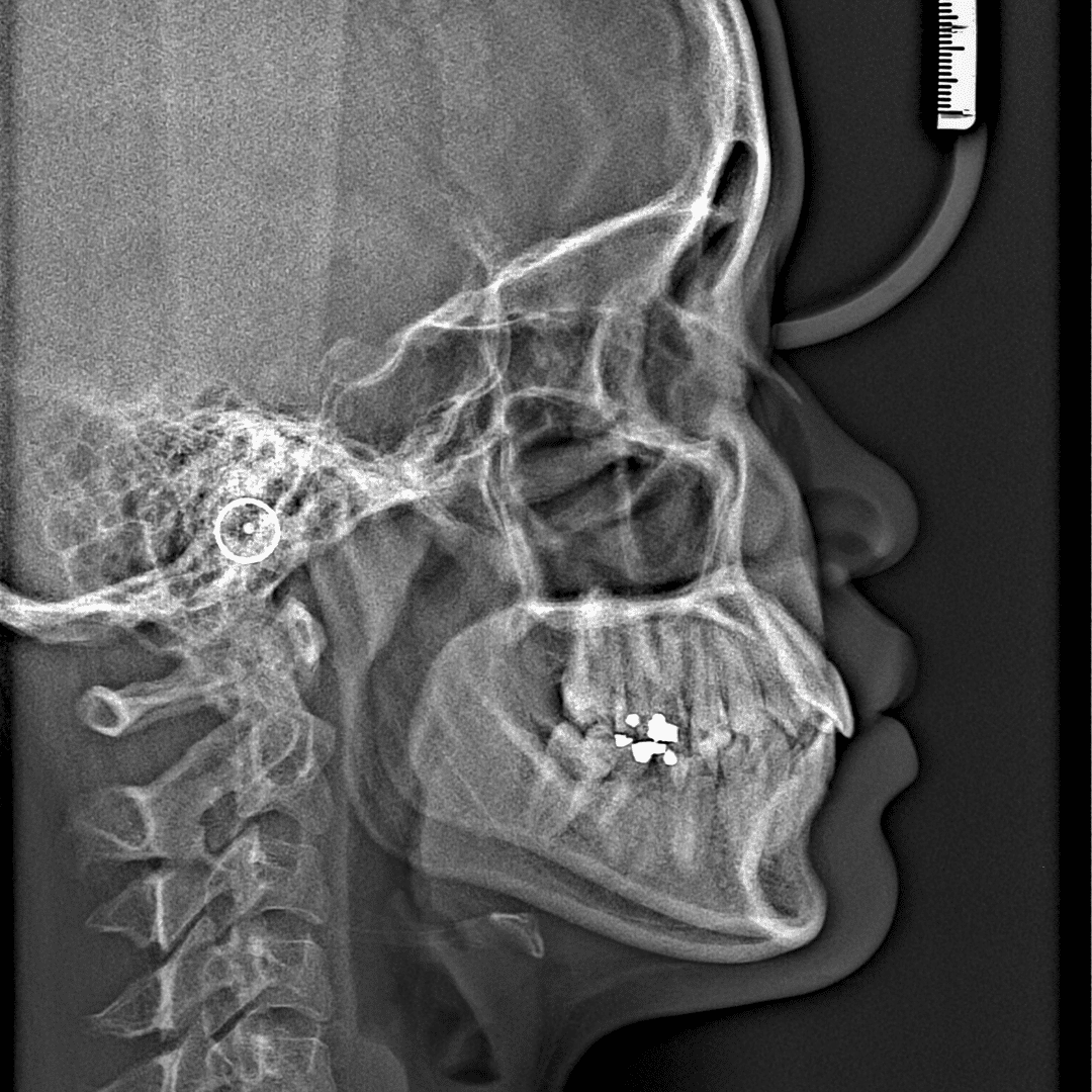 TMJ Treatment in Turkey, TMD Treatment